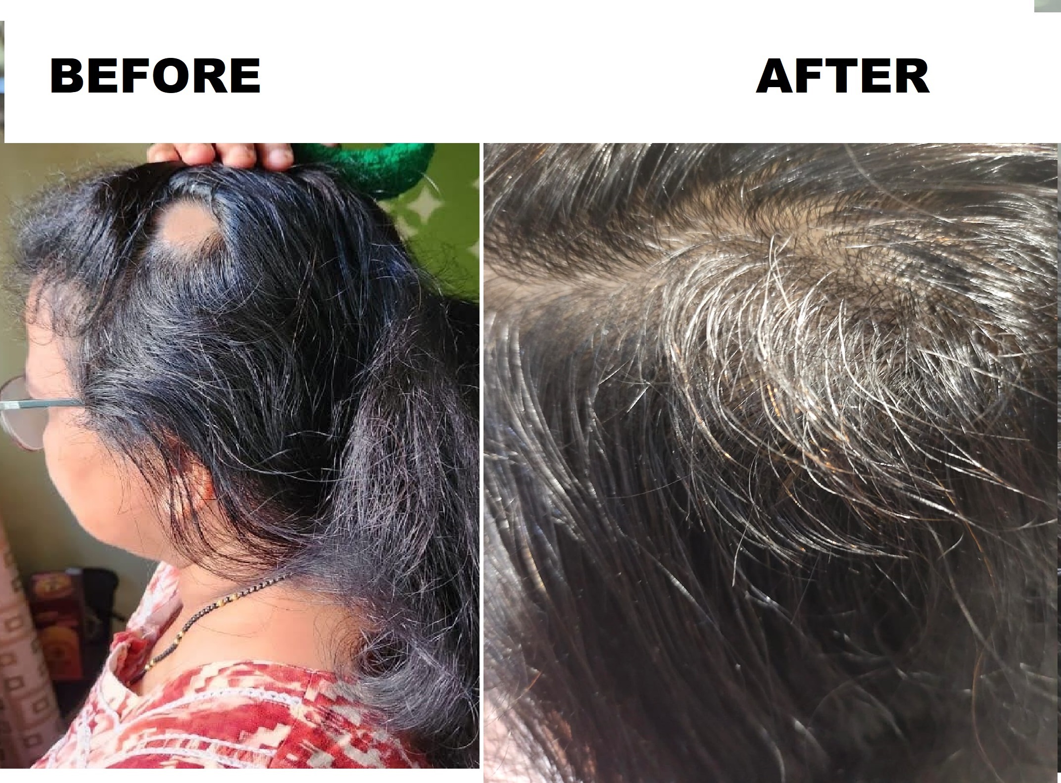 Hair regrowth treatment